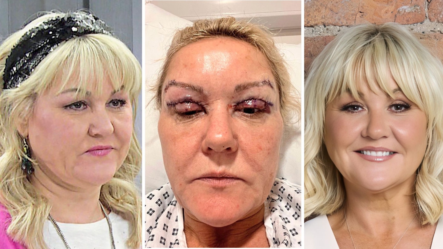 lisa george before and after eye surgery